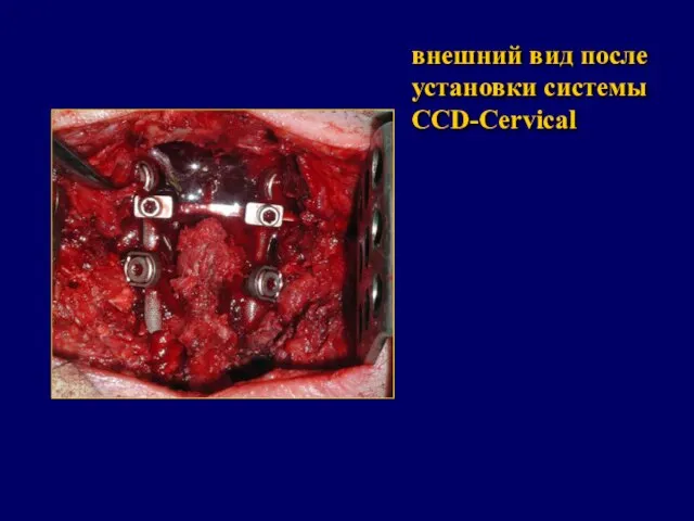 внешний вид после установки системы CCD-Cervical