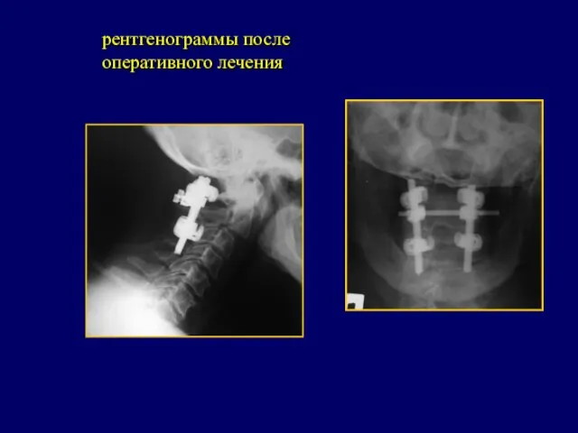 рентгенограммы после оперативного лечения