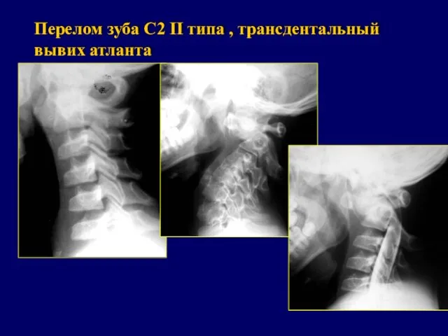 Перелом зуба С2 II типа , трансдентальный вывих атланта