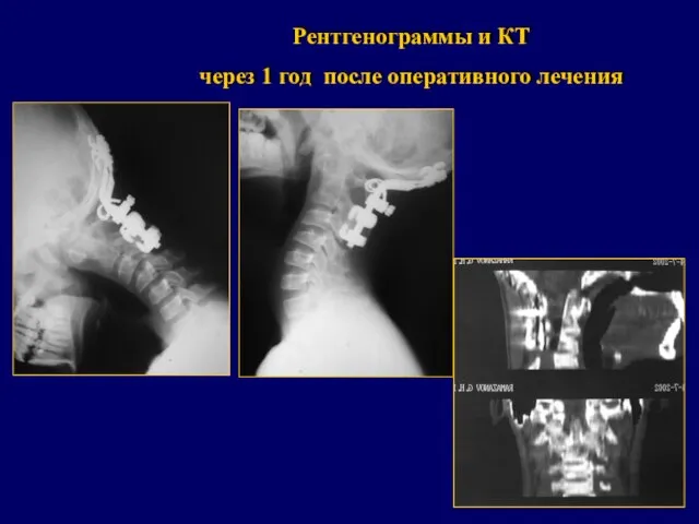 Рентгенограммы и КТ через 1 год после оперативного лечения