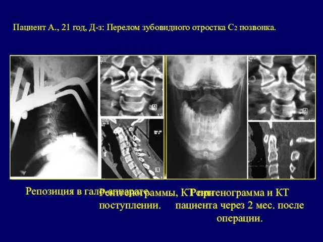 Пациент А., 21 год, Д-з: Перелом зубовидного отростка С2 позвонка. Рентгенограммы,