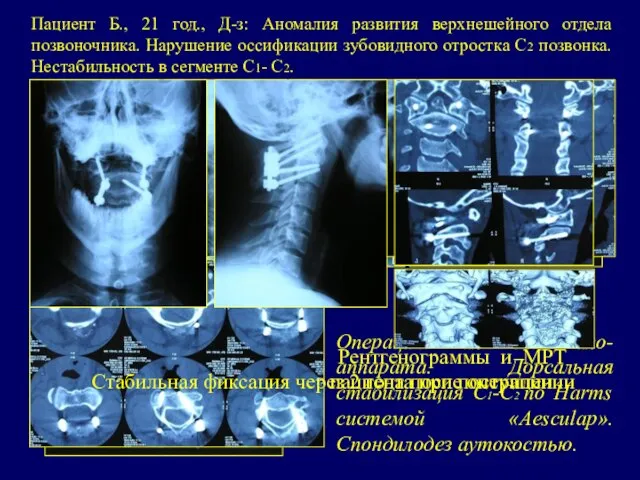 Пациент Б., 21 год., Д-з: Аномалия развития верхнешейного отдела позвоночника. Нарушение