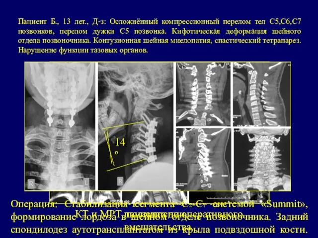 Пациент Б., 13 лет., Д-з: Осложнённый компрессионный перелом тел C5,C6,C7 позвонков,