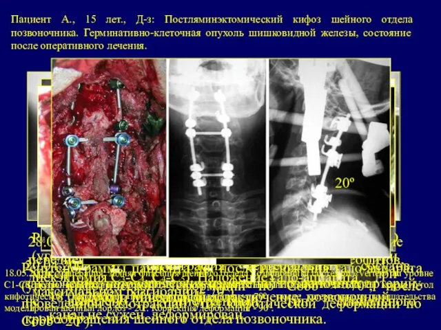 Пациент А., 15 лет., Д-з: Постляминэктомический кифоз шейного отдела позвоночника. Герминативно-клеточная