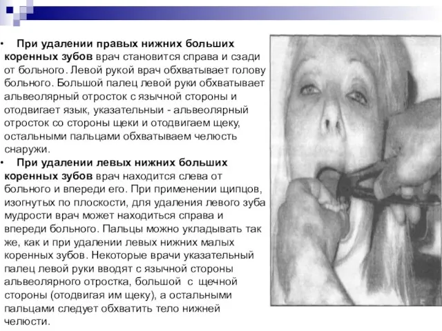 При удалении правых нижних больших коренных зубов врач становится справа и