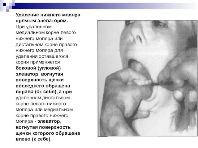 Удаление нижнего моляра прямым элеватором. При удаленном медиальном корне левого нижнего