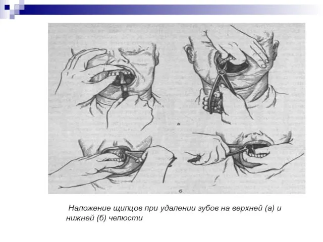 Наложение щипцов при удалении зубов на верхней (а) и нижней (б) челюсти
