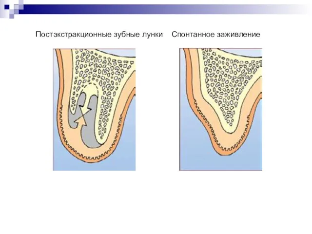 Постэкстракционные зубные лунки Спонтанное заживление НКР/НРТ/Мягкая ткань