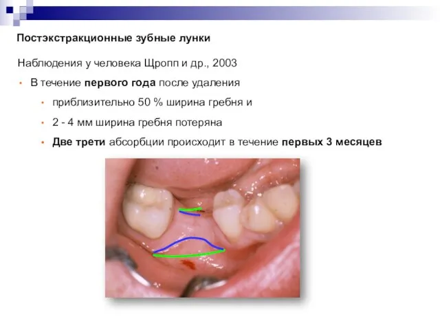 Постэкстракционные зубные лунки Коллаген Наблюдения у человека Щропп и др., 2003