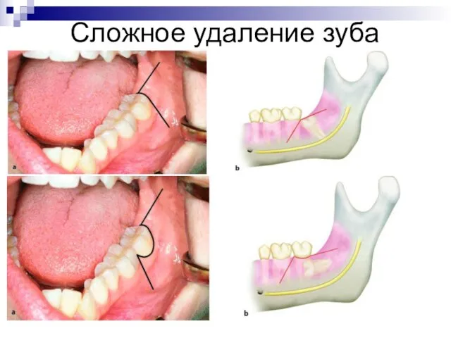 Сложное удаление зуба