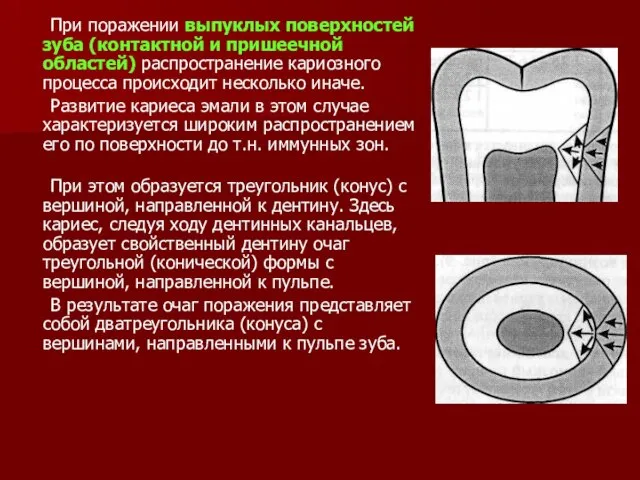 При поражении выпуклых поверхностей зуба (контактной и пришеечной областей) распространение кариозного