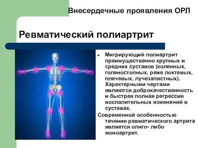 Ревматический полиартрит Мигрирующий полиартрит преимущественно крупных и средних суставов (коленных, голеностопных,