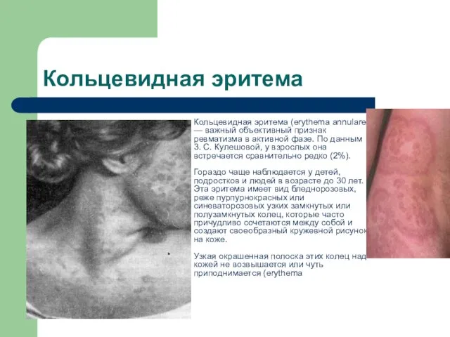 Кольцевидная эритема Кольцевидная эритема (erythema annulare) — важный объективный признак ревматизма