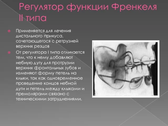 Регулятор функции Френкеля II типа Применяется для лечения дистального прикуса, сочетающегося