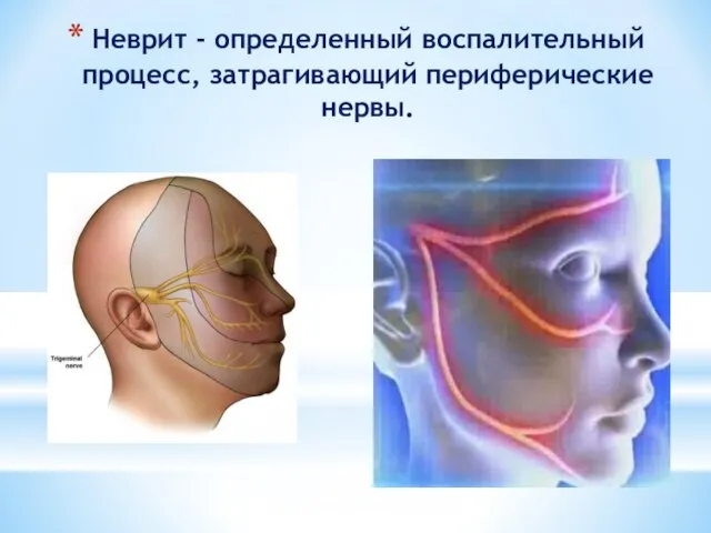 Неврит - определенный воспалительный процесс, затрагивающий периферические нервы.