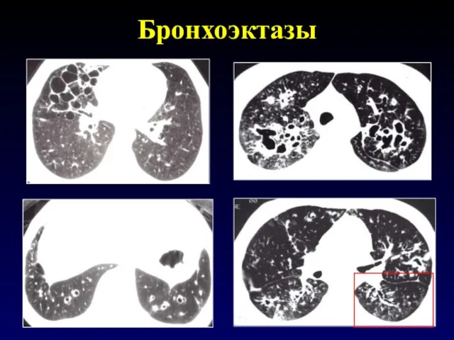 Бронхоэктазы