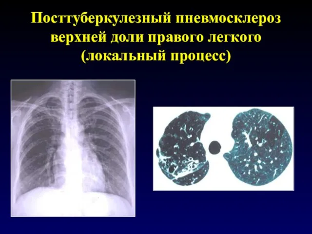 Посттуберкулезный пневмосклероз верхней доли правого легкого (локальный процесс)