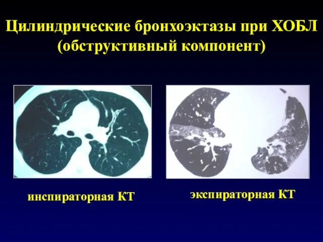 Цилиндрические бронхоэктазы при ХОБЛ (обструктивный компонент) инспираторная КТ экспираторная КТ