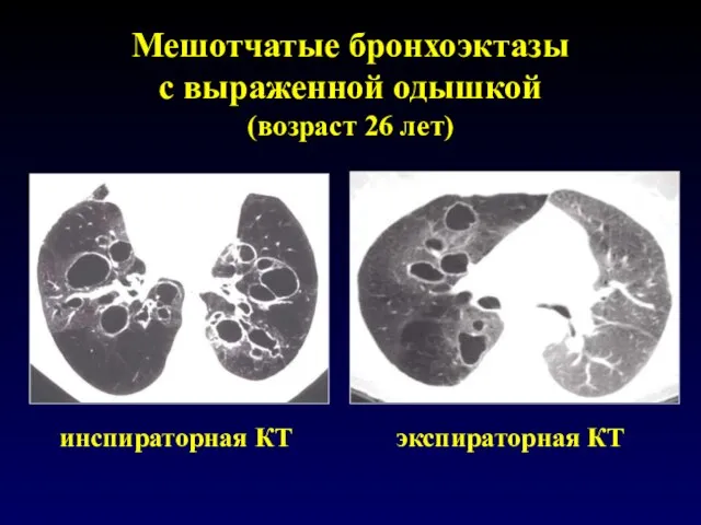 Мешотчатые бронхоэктазы с выраженной одышкой (возраст 26 лет) инспираторная КТ экспираторная КТ