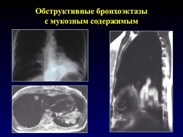 Обструктивные бронхоэктазы с мукозным содержимым