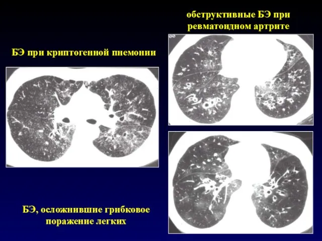 обструктивные БЭ при ревматоидном артрите БЭ при криптогенной пнемонии БЭ, осложнившие грибковое поражение легких