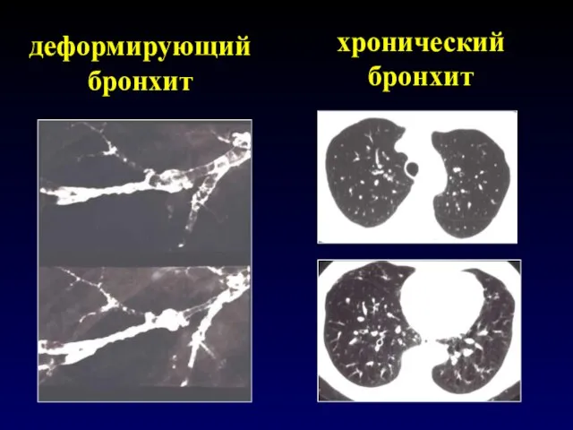 деформирующий бронхит хронический бронхит