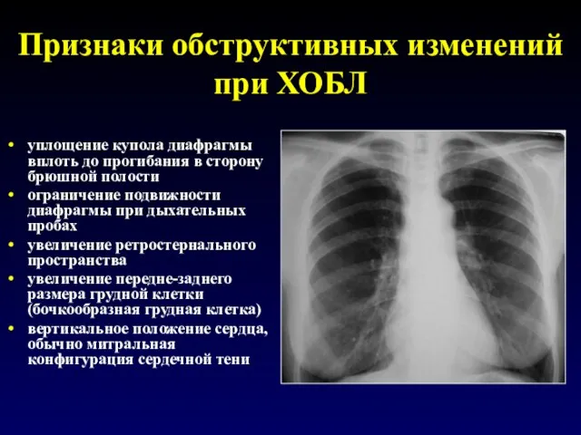 Признаки обструктивных изменений при ХОБЛ уплощение купола диафрагмы вплоть до прогибания