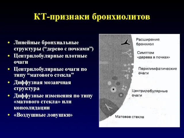 КТ-признаки бронхиолитов Линейные бронхиальные структуры (“дерево с почками”) Центрилобулярные плотные очаги