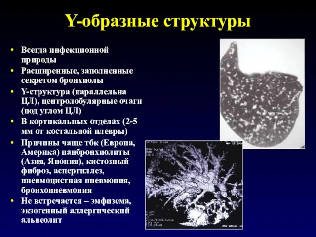 Y-образные структуры Всегда инфекционной природы Расширенные, заполненные секретом бронхиолы Y-структура (параллельна