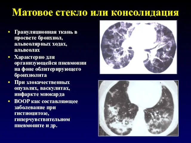 Матовое стекло или консолидация Грануляционная ткань в просвете бронхиол, альвеолярных ходах,