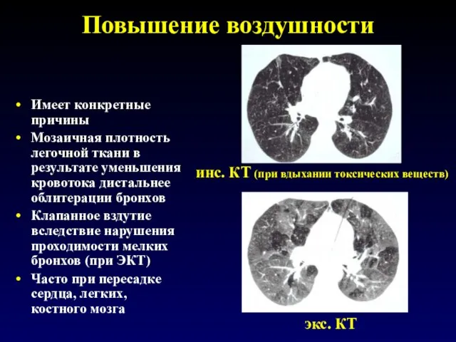 Повышение воздушности Имеет конкретные причины Мозаичная плотность легочной ткани в результате