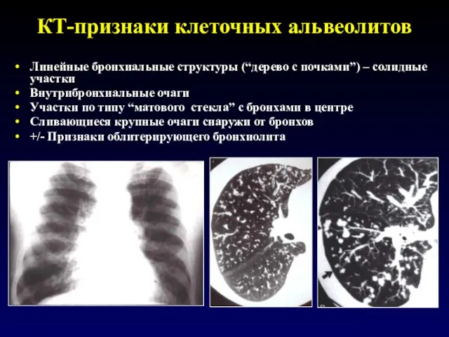 КТ-признаки клеточных альвеолитов Линейные бронхиальные структуры (“дерево с почками”) – солидные