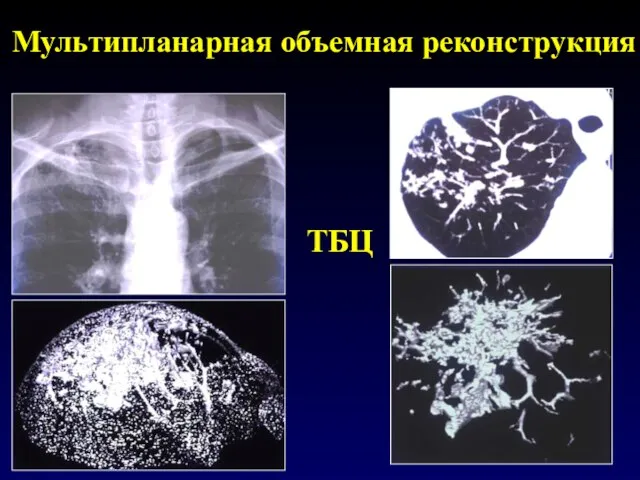 Мультипланарная объемная реконструкция ТБЦ