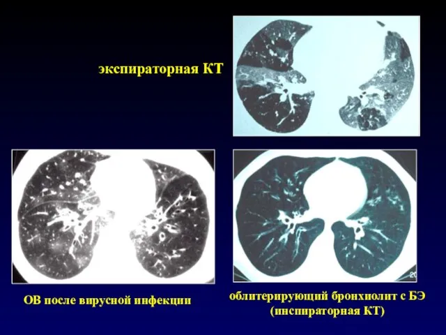 OB после вирусной инфекции облитерирующий бронхиолит с БЭ (инспираторная КТ) экспираторная КТ