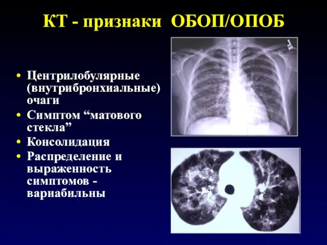 КТ - признаки ОБОП/ОПОБ Центрилобулярные (внутрибронхиальные) очаги Симптом “матового стекла” Консолидация