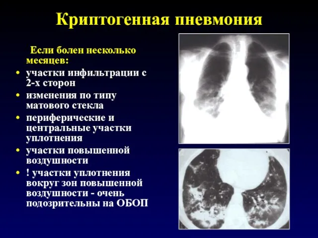 Криптогенная пневмония Если болен несколько месяцев: участки инфильтрации с 2-х сторон