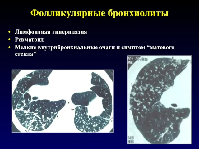 Фолликулярные бронхиолиты Лимфоидная гиперплазия Ревматоид Мелкие внутрибронхиальные очаги и симптом “матового стекла”