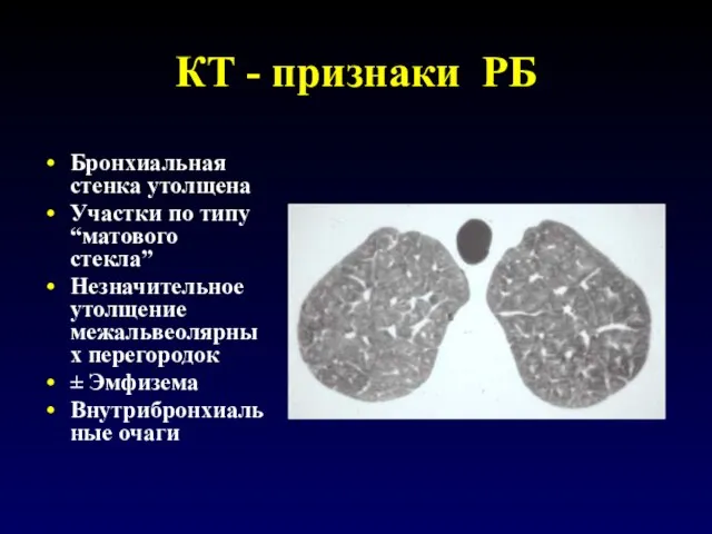 КТ - признаки РБ Бронхиальная стенка утолщена Участки по типу “матового