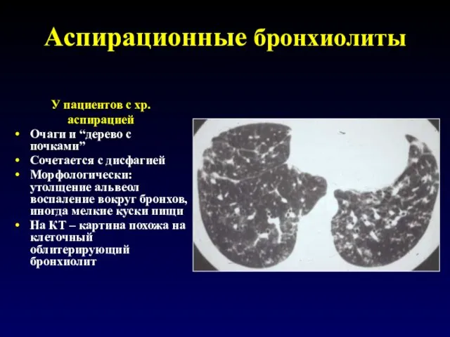 Аспирационные бронхиолиты У пациентов с хр. аспирацией Очаги и “дерево с