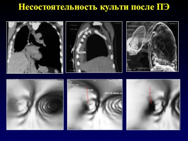 Несостоятельность культи после ПЭ