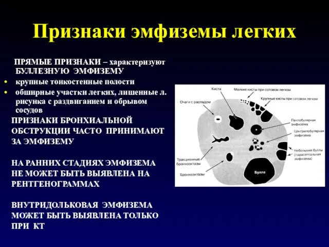 Признаки эмфиземы легких ПРЯМЫЕ ПРИЗНАКИ – характеризуют БУЛЛЕЗНУЮ ЭМФИЗЕМУ крупные тонкостенные