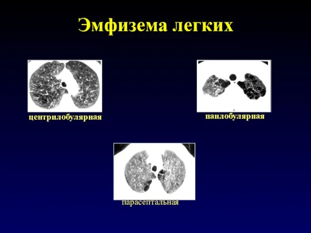 Эмфизема легких центрилобулярная панлобулярная парасептальная
