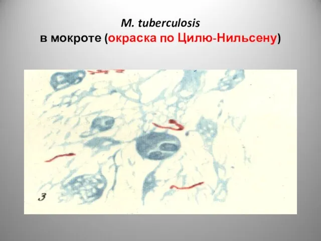 M. tuberculosis в мокроте (окраска по Цилю-Нильсену)