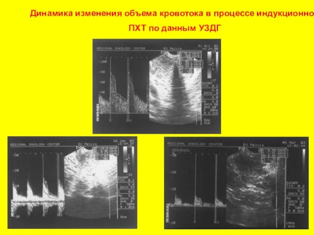 Динамика изменения объема кровотока в процессе индукционной ПХТ по данным УЗДГ