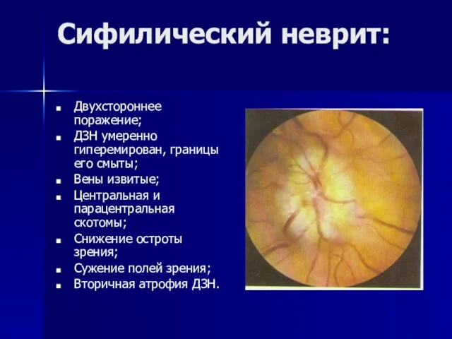 Сифилический неврит: Двухстороннее поражение; ДЗН умеренно гиперемирован, границы его смыты; Вены