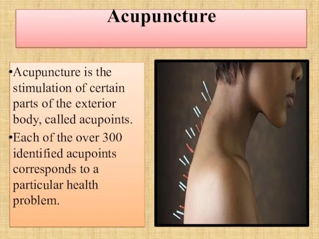 Acupuncture Acupuncture is the stimulation of certain parts of the exterior