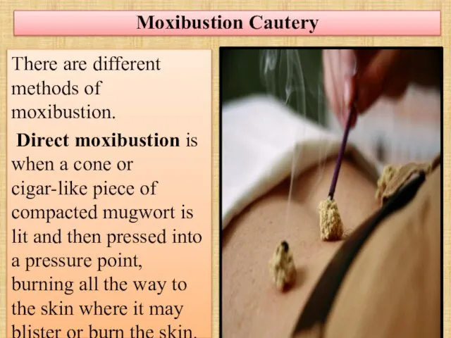 Moxibustion Cautery There are different methods of moxibustion. Direct moxibustion is