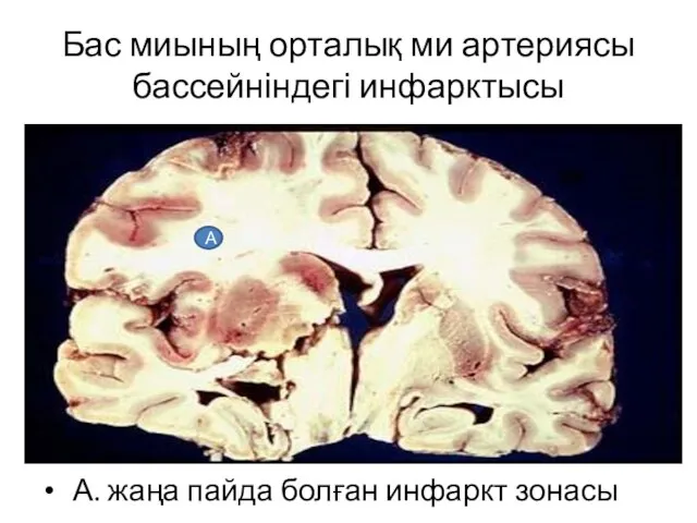 А. жаңа пайда болған инфаркт зонасы А Бас миының орталық ми артериясы бассейніндегі инфарктысы