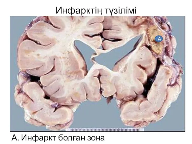 Инфарктің түзілімі А. Инфаркт болған зона А