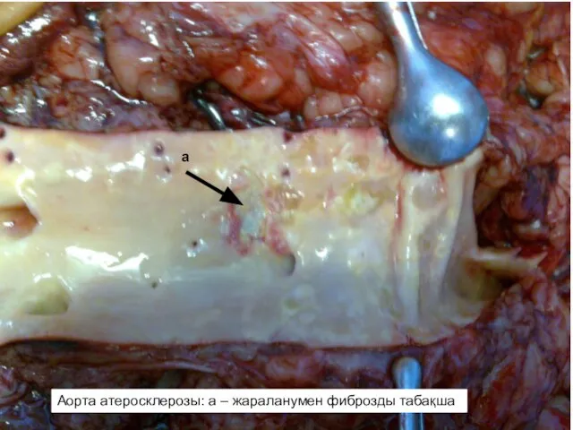 Атеросклероз аорты: а - фиброзная бляшка с изъязвлением а Аорта атеросклерозы: а – жараланумен фиброзды табақша